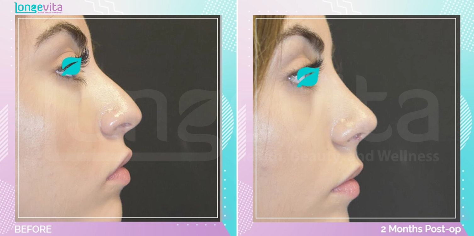 Rhinoplasty before and after, Face
