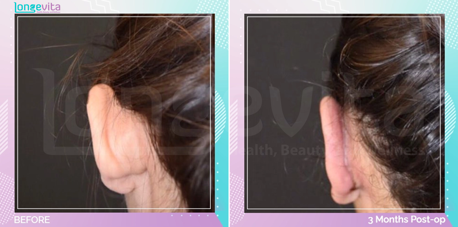 Otoplasty before and after, Face