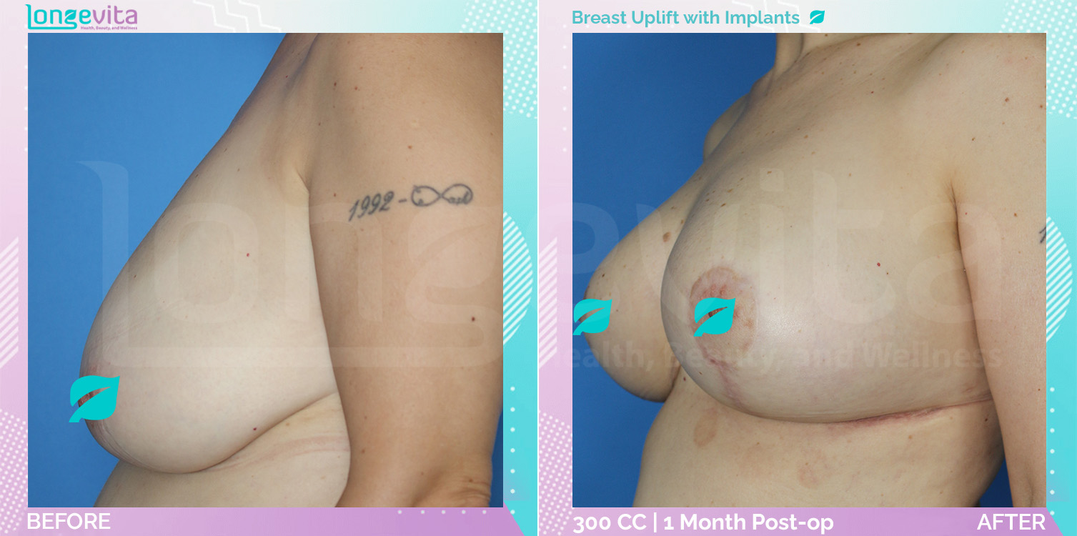 Breast Enlargement and Breast Lift before and after, Breast