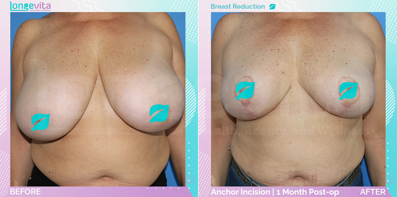 Breast Reduction before and after, Breast