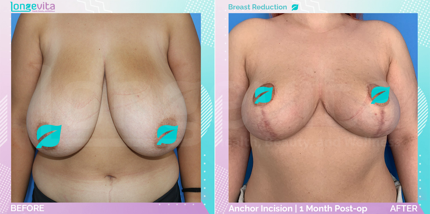 Breast Reduction before and after, Breast