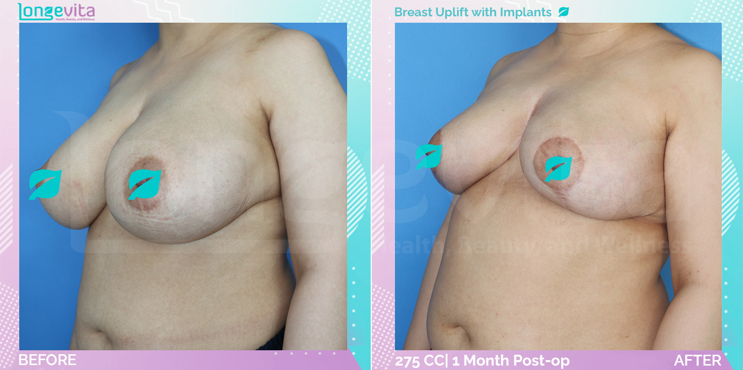 Breast Enlargement and Breast Lift before and after, Breast