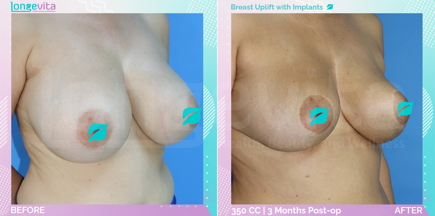 Breast Enlargement and Breast Lift before and after, Breast