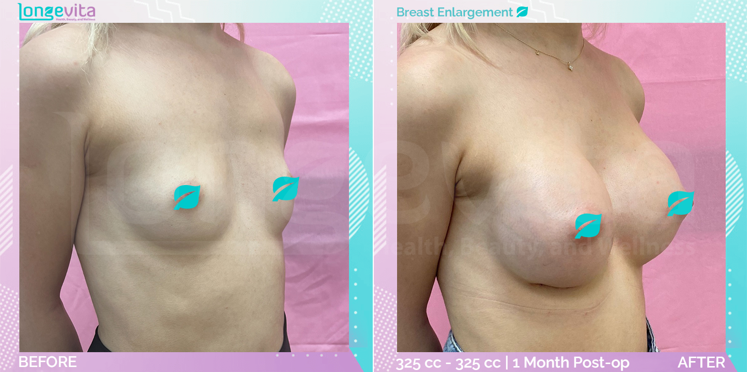 Breast Enlargement before and after, Breast