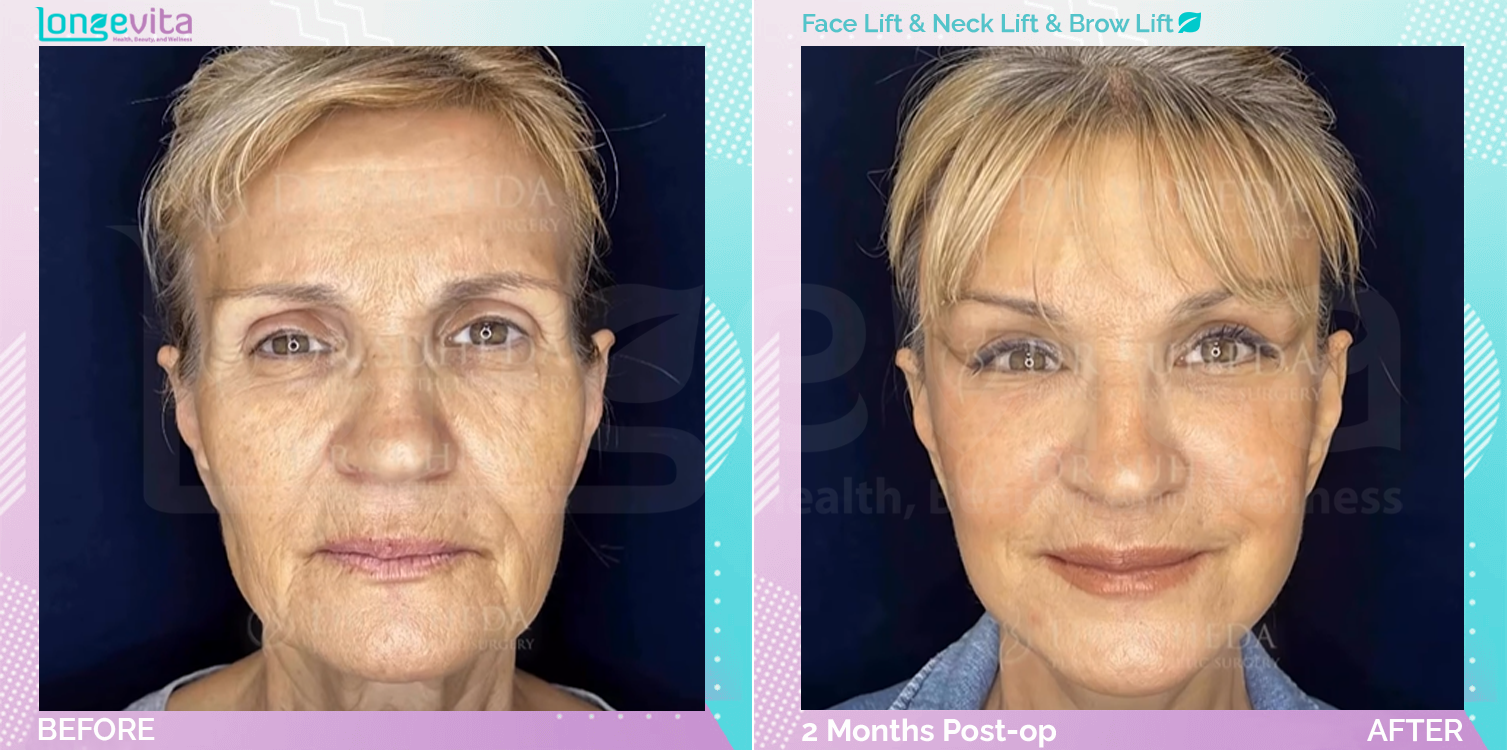 Eyebow Lift and Facelift and Neck Lift before and after, Face