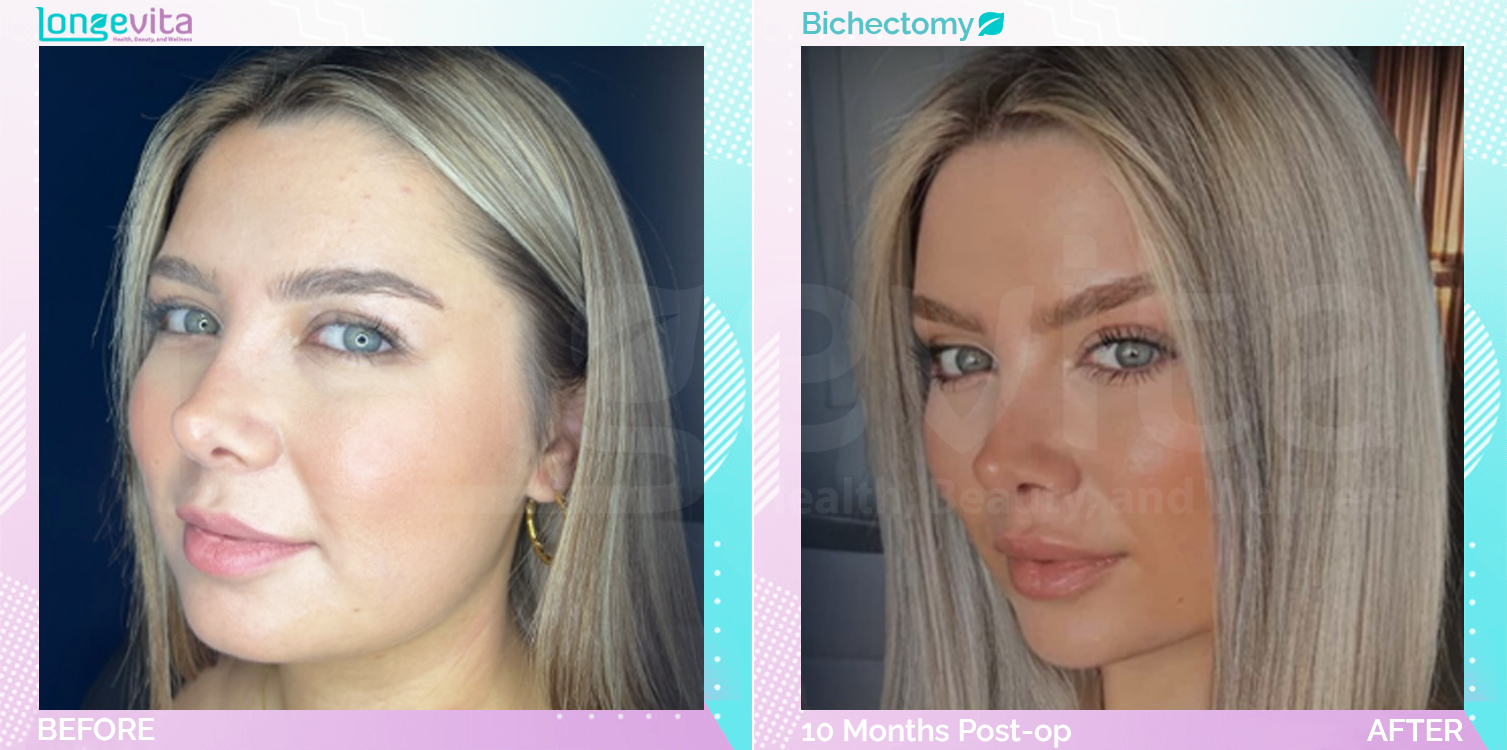 Bichectomy before and after, Face