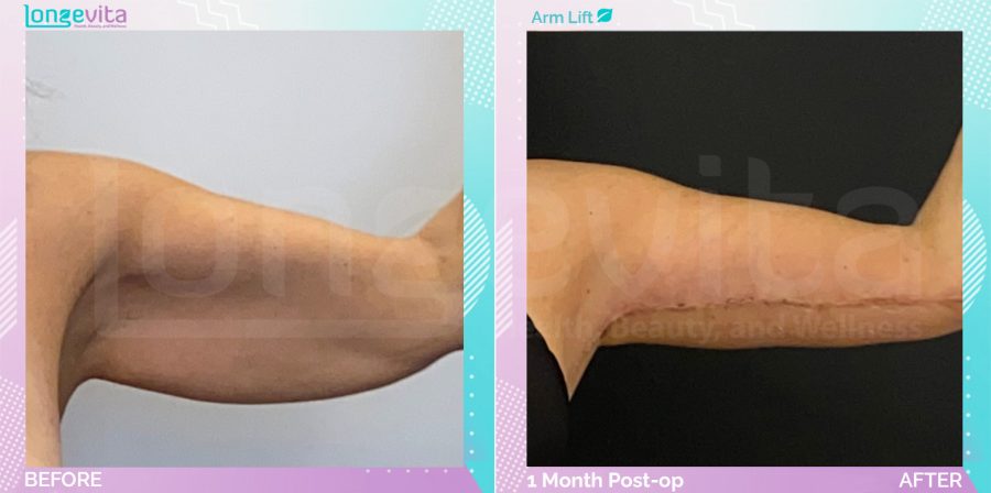 Arm Lift before and after, Body