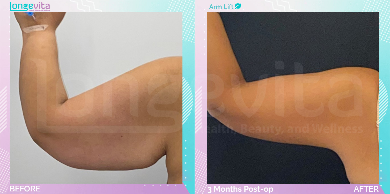 Arm Lift before and after, Body