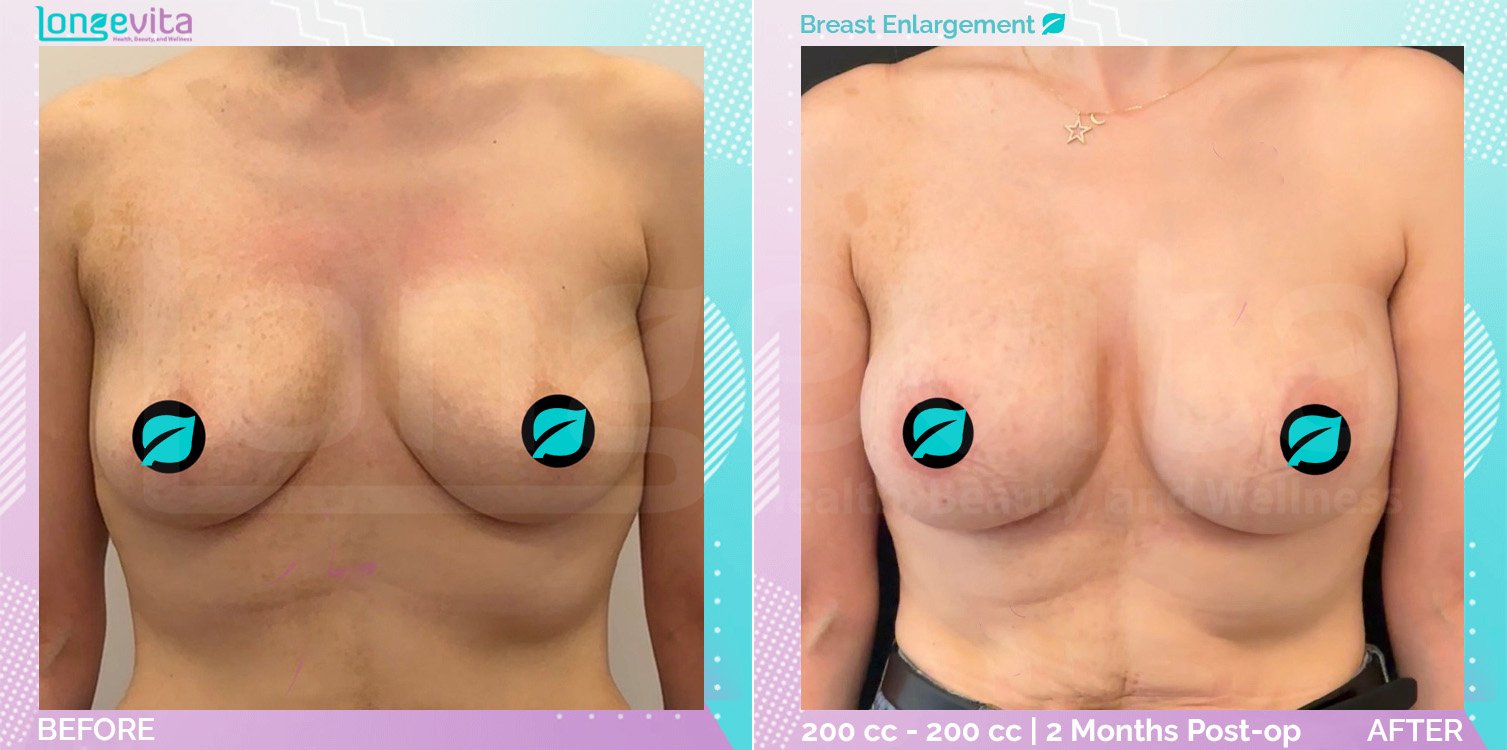 Breast Enlargement before and after, Breast