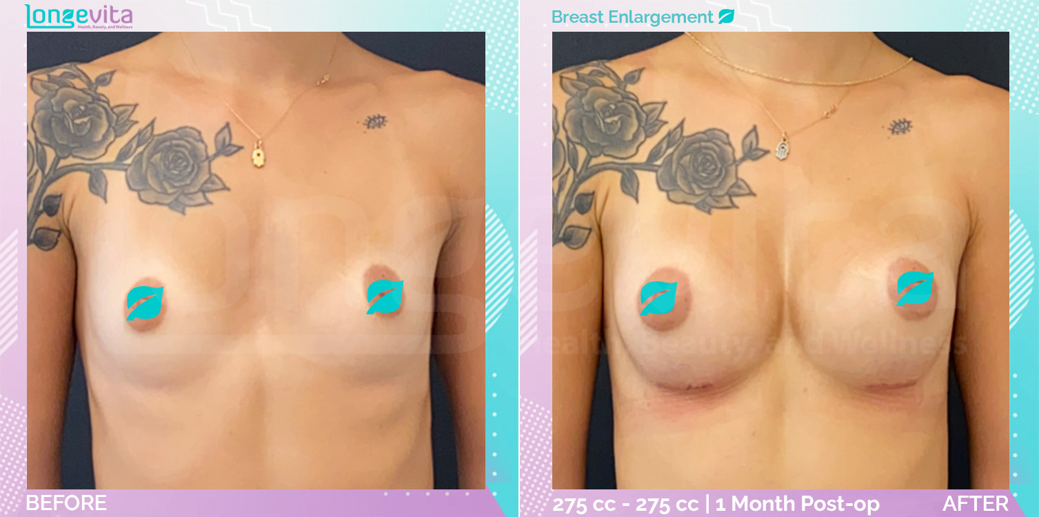 Breast Enlargement before and after, Breast