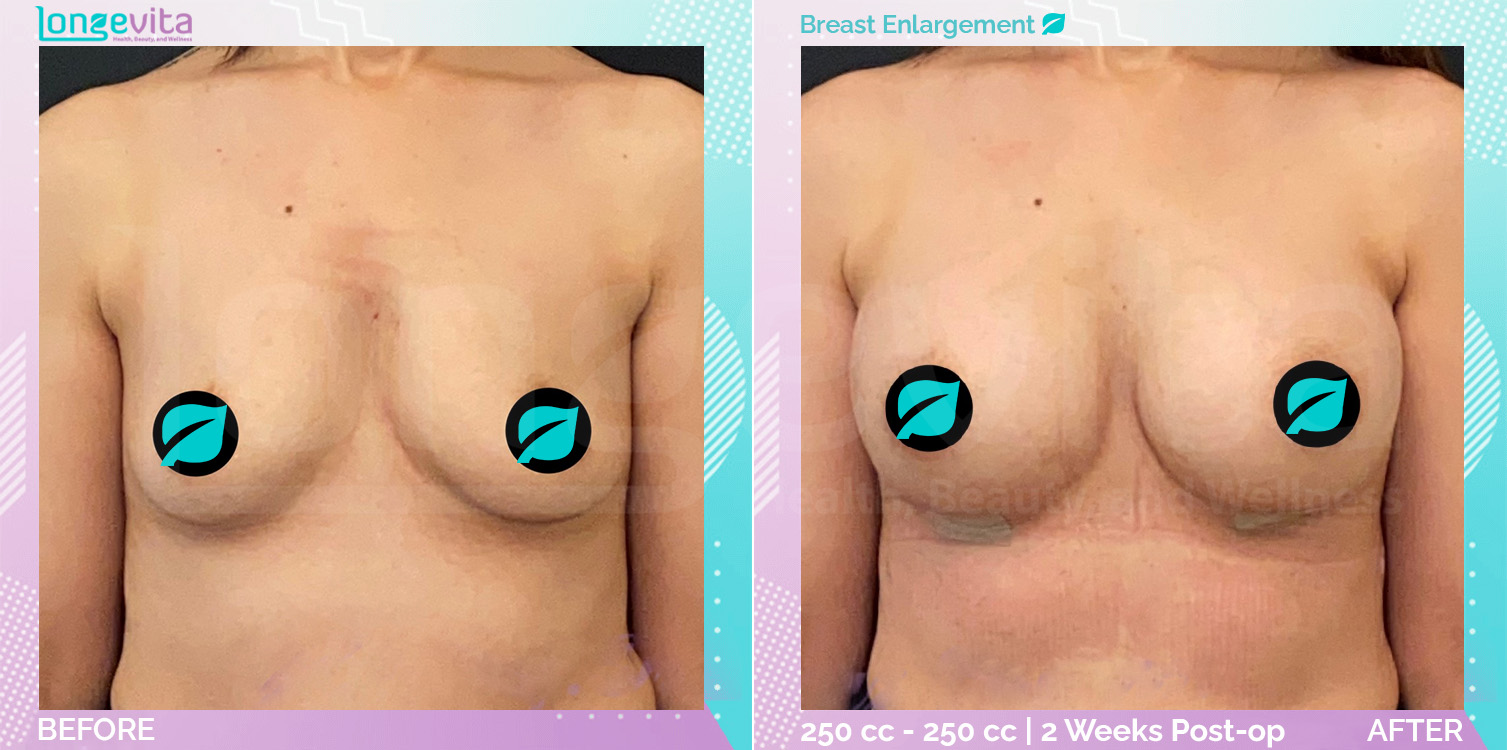 Breast Enlargement before and after, Breast