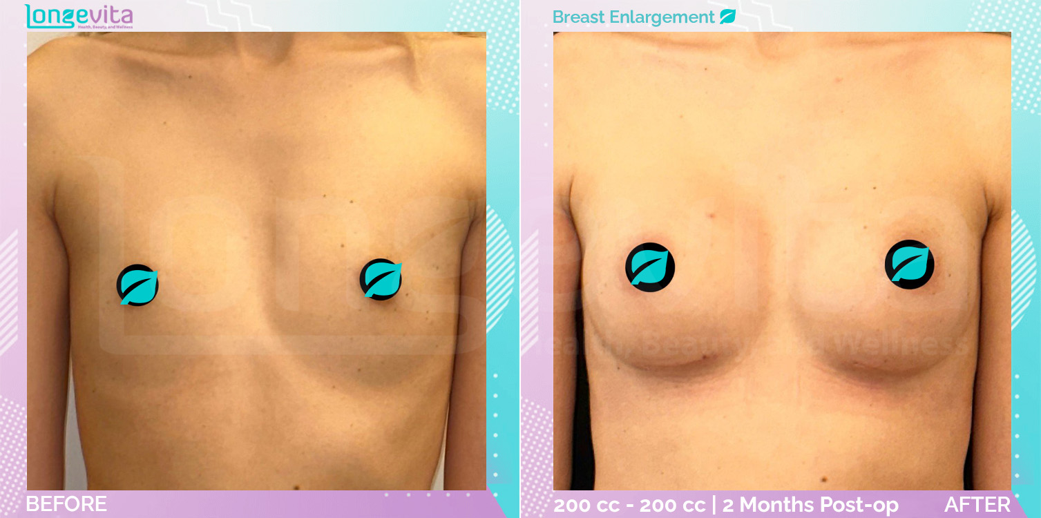 Breast Enlargement before and after, Breast