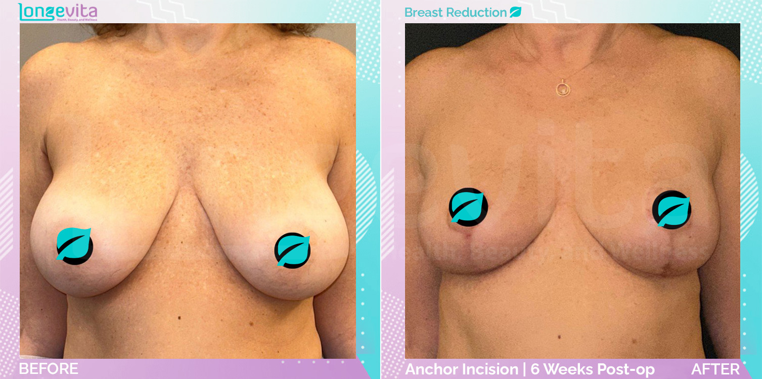 Breast Reduction before and after, Breast