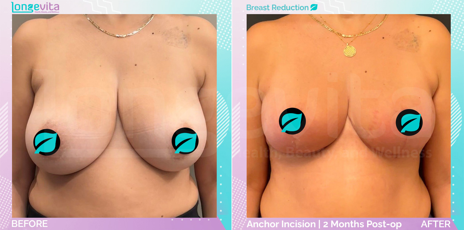 Breast Reduction before and after, Breast