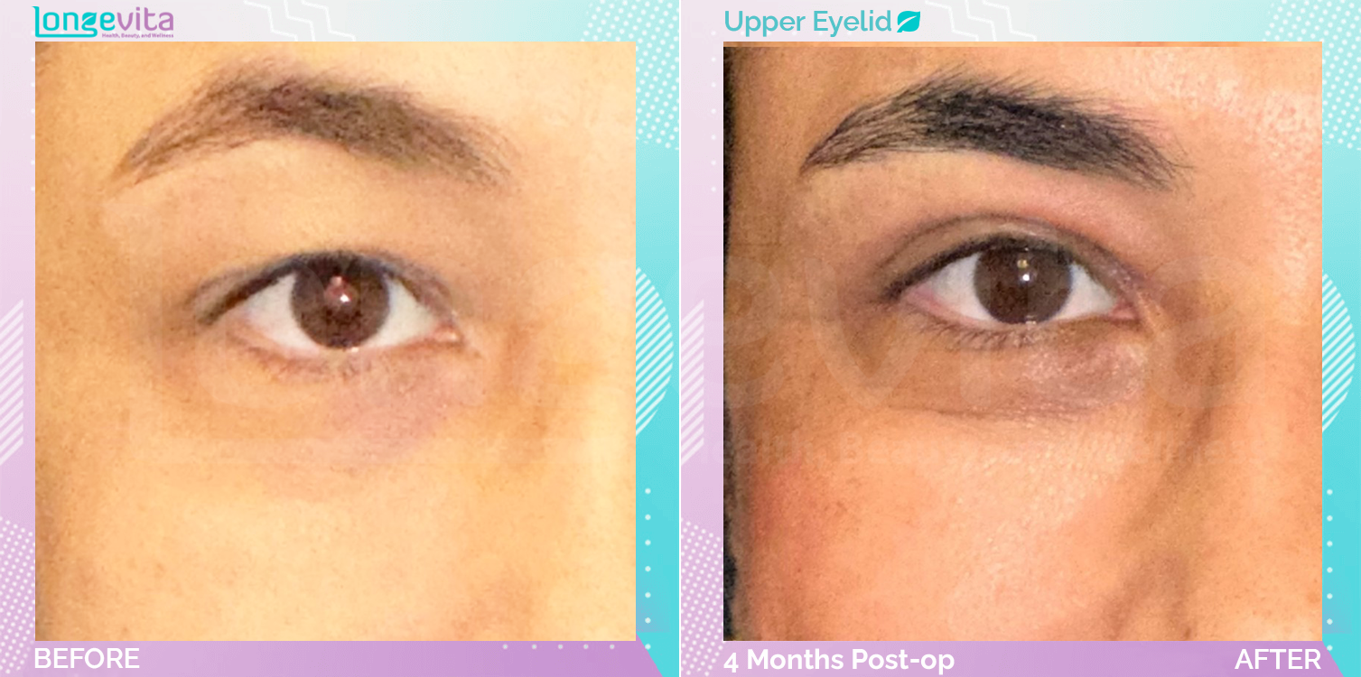 Eyelid before and after, Face