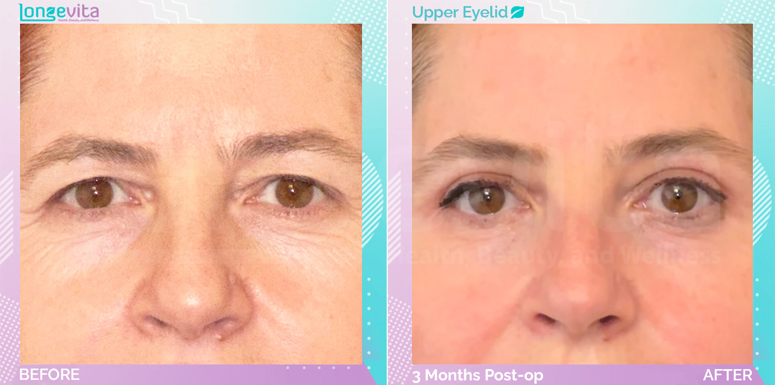 Eyelid before and after, Face