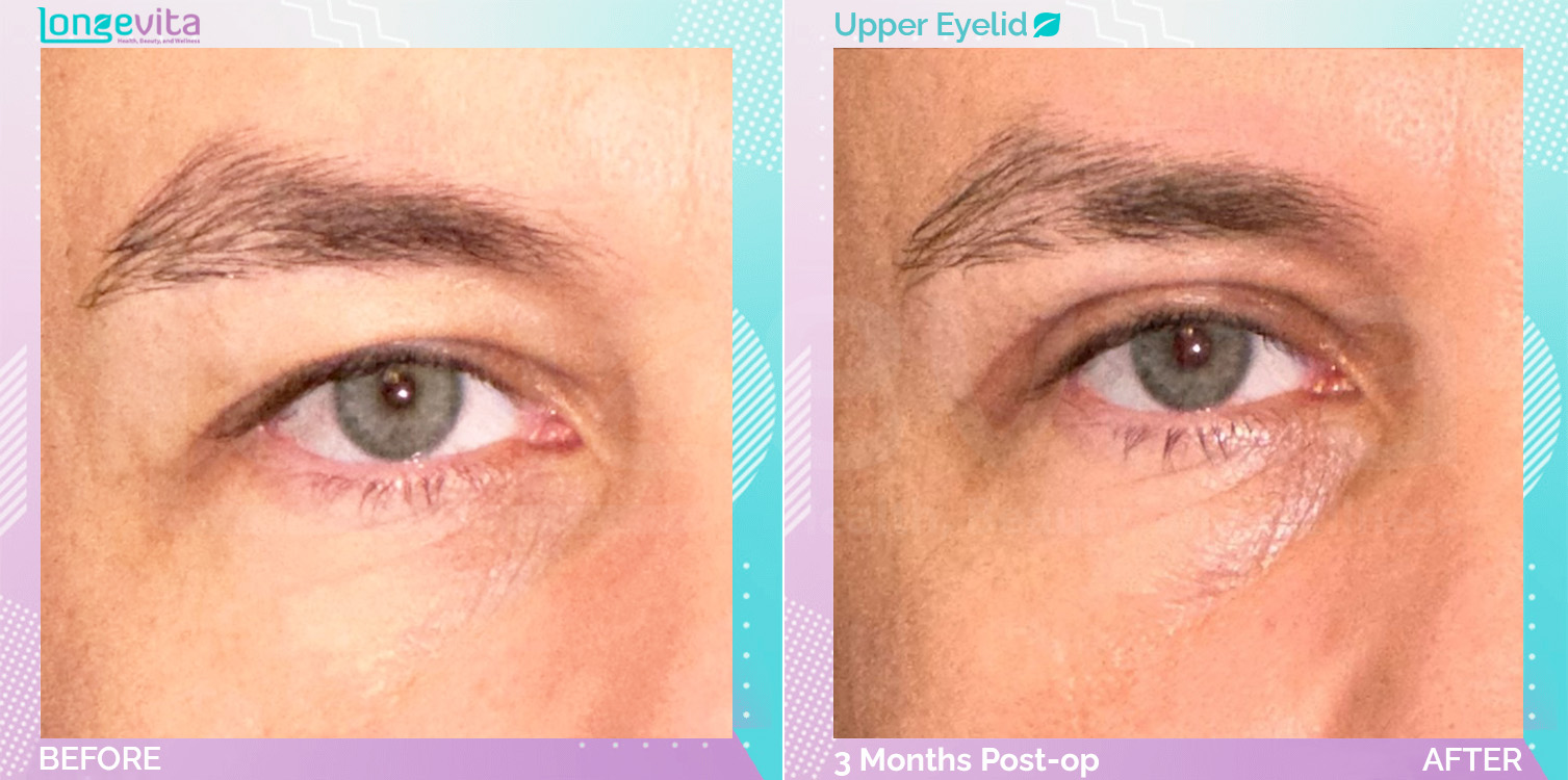 Eyelid before and after, Face
