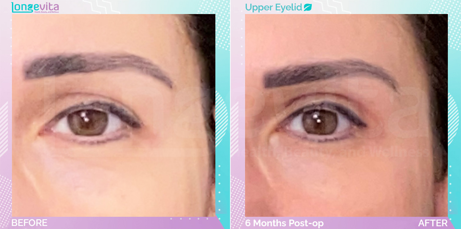 Eyelid before and after, Face