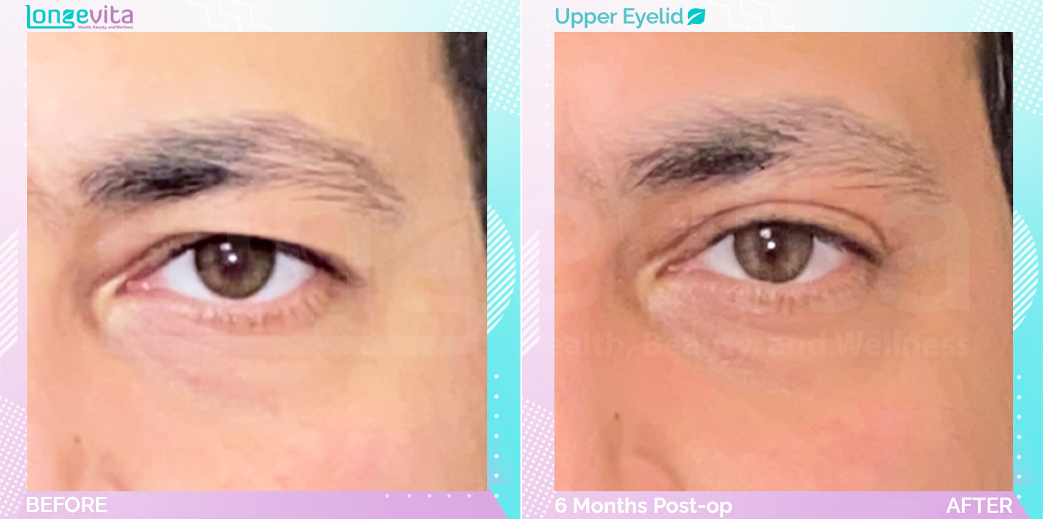 Eyelid before and after, Face