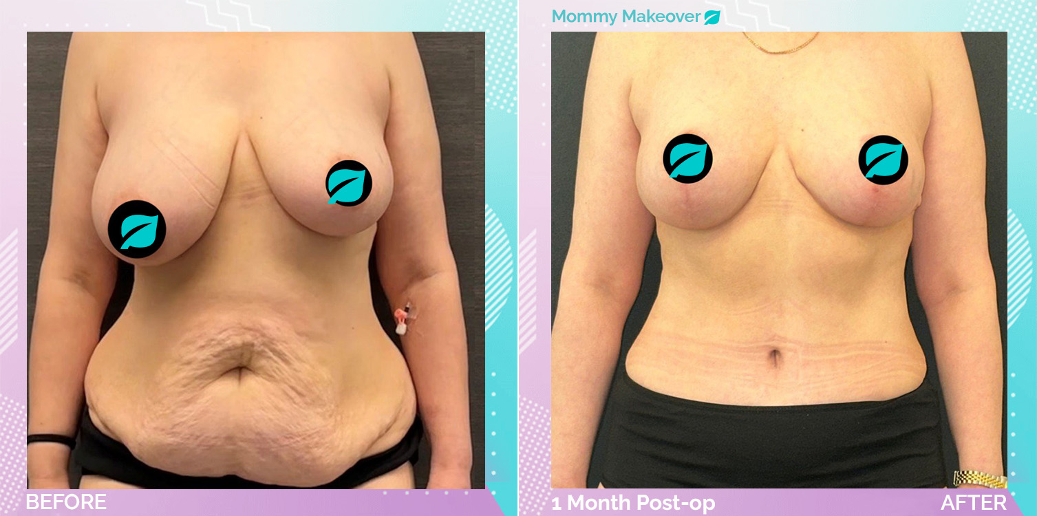 Breast Reduction and Liposuction and Tummy Tuck before and after, Body