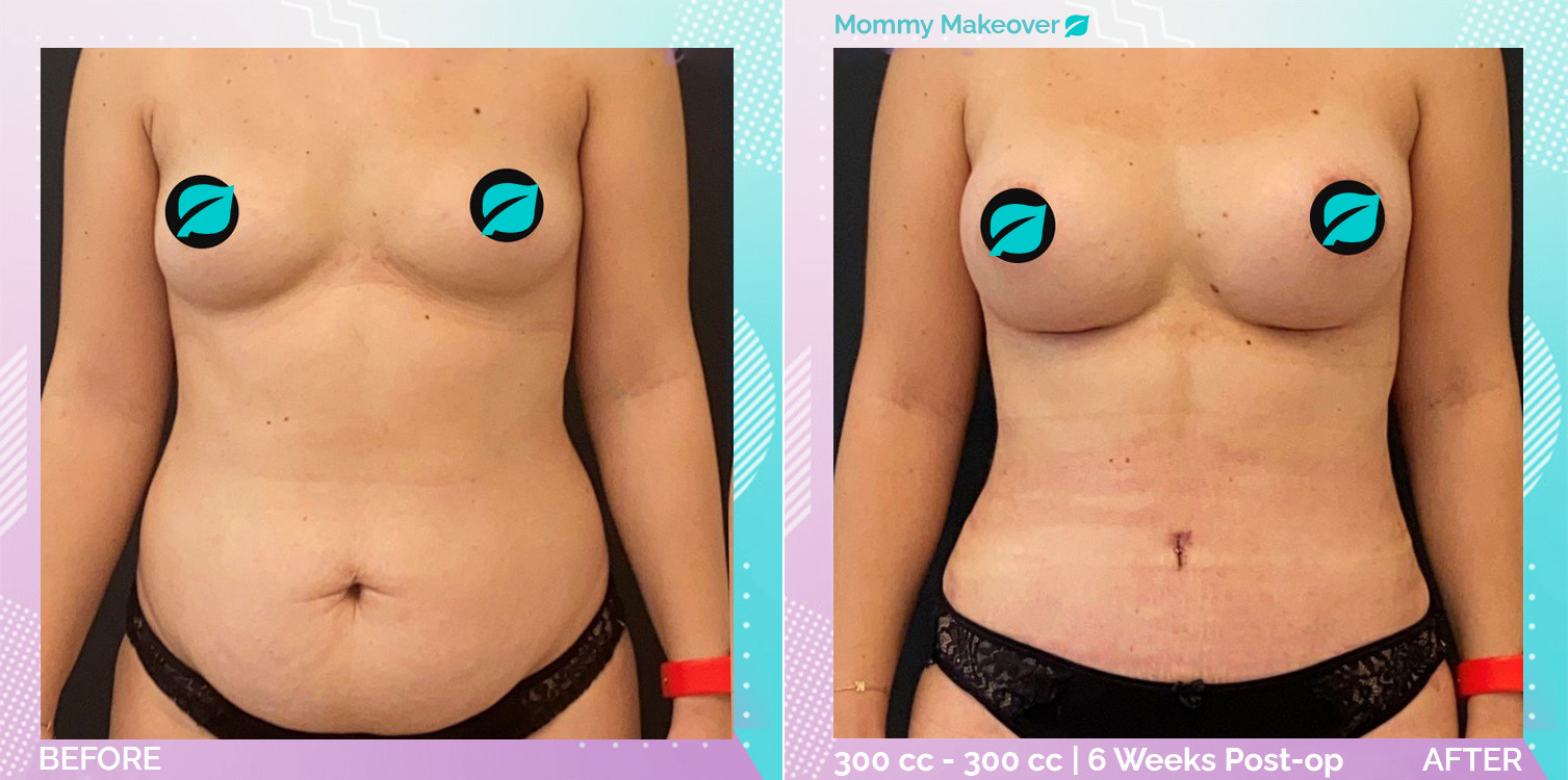 Breast Enlargement and Liposuction and Tummy Tuck before and after, Body