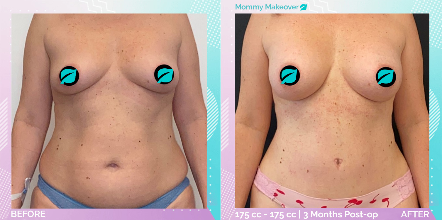 Breast Enlargement and Liposuction and Tummy Tuck before and after, Body