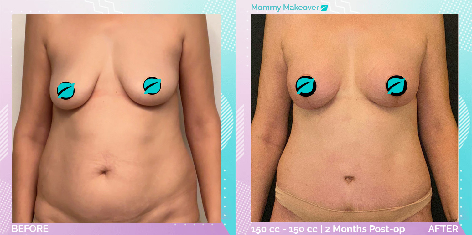 Breast Enlargement and Breast Lift and Liposuction and Tummy Tuck before and after, Body