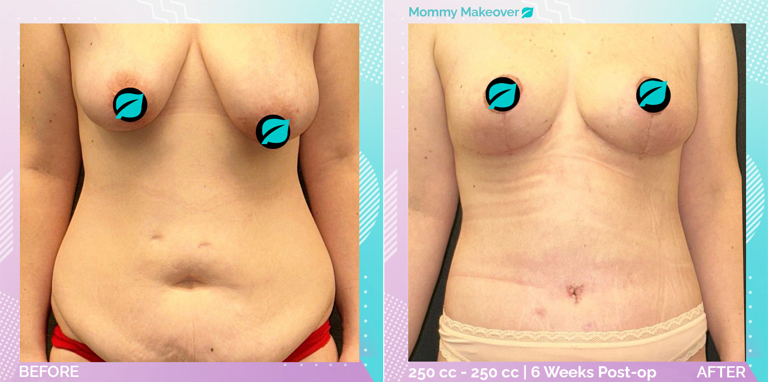 Breast Enlargement and Breast Lift and Liposuction and Tummy Tuck before and after, Body