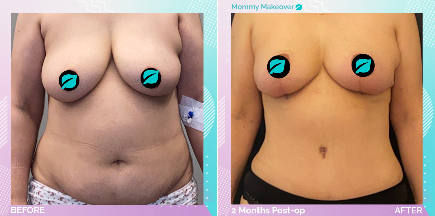 Breast Reduction and Liposuction and Tummy Tuck before and after, Body