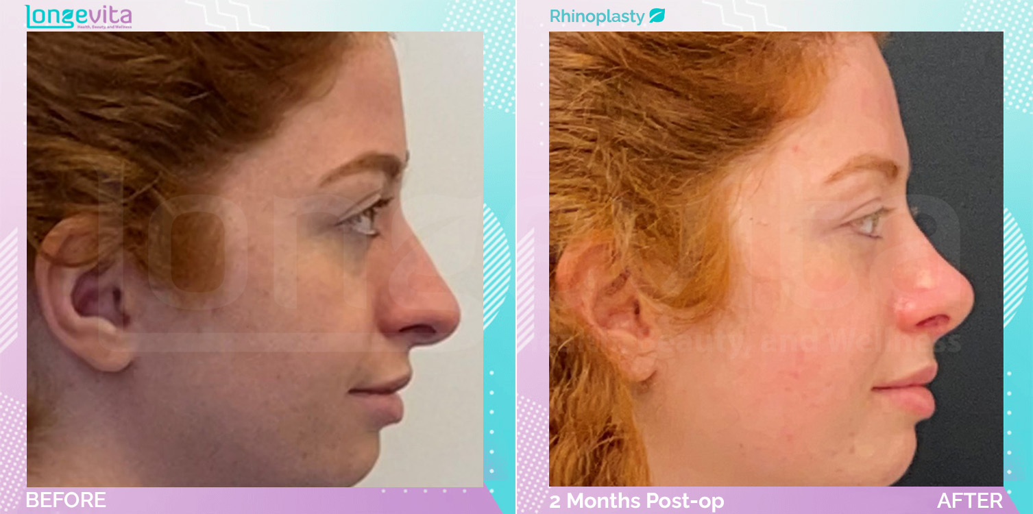 Rhinoplasty before and after, Face
