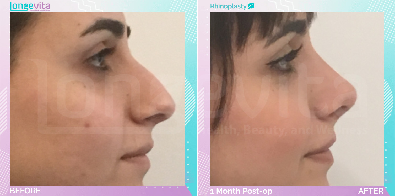 Rhinoplasty before and after, Face