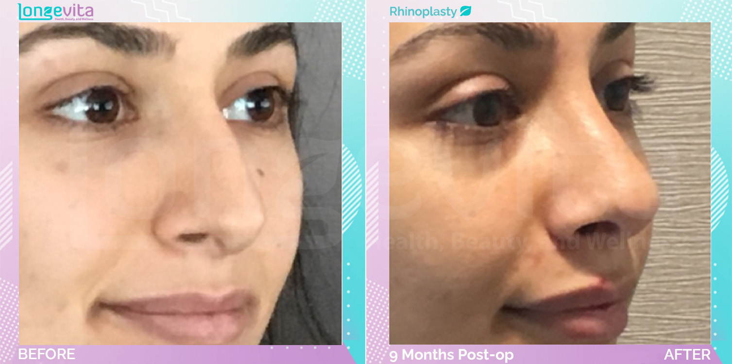 Rhinoplasty before and after, Face