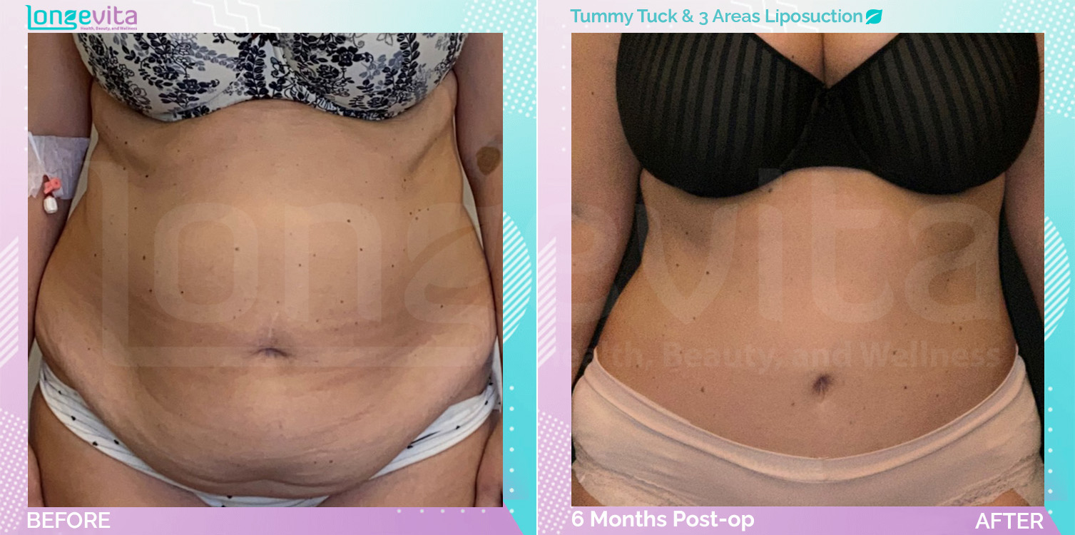 Liposuction and Tummy Tuck before and after, Body