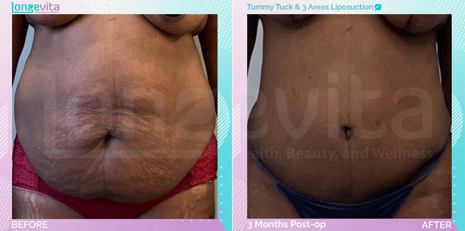 Liposuction and Tummy Tuck before and after, Body