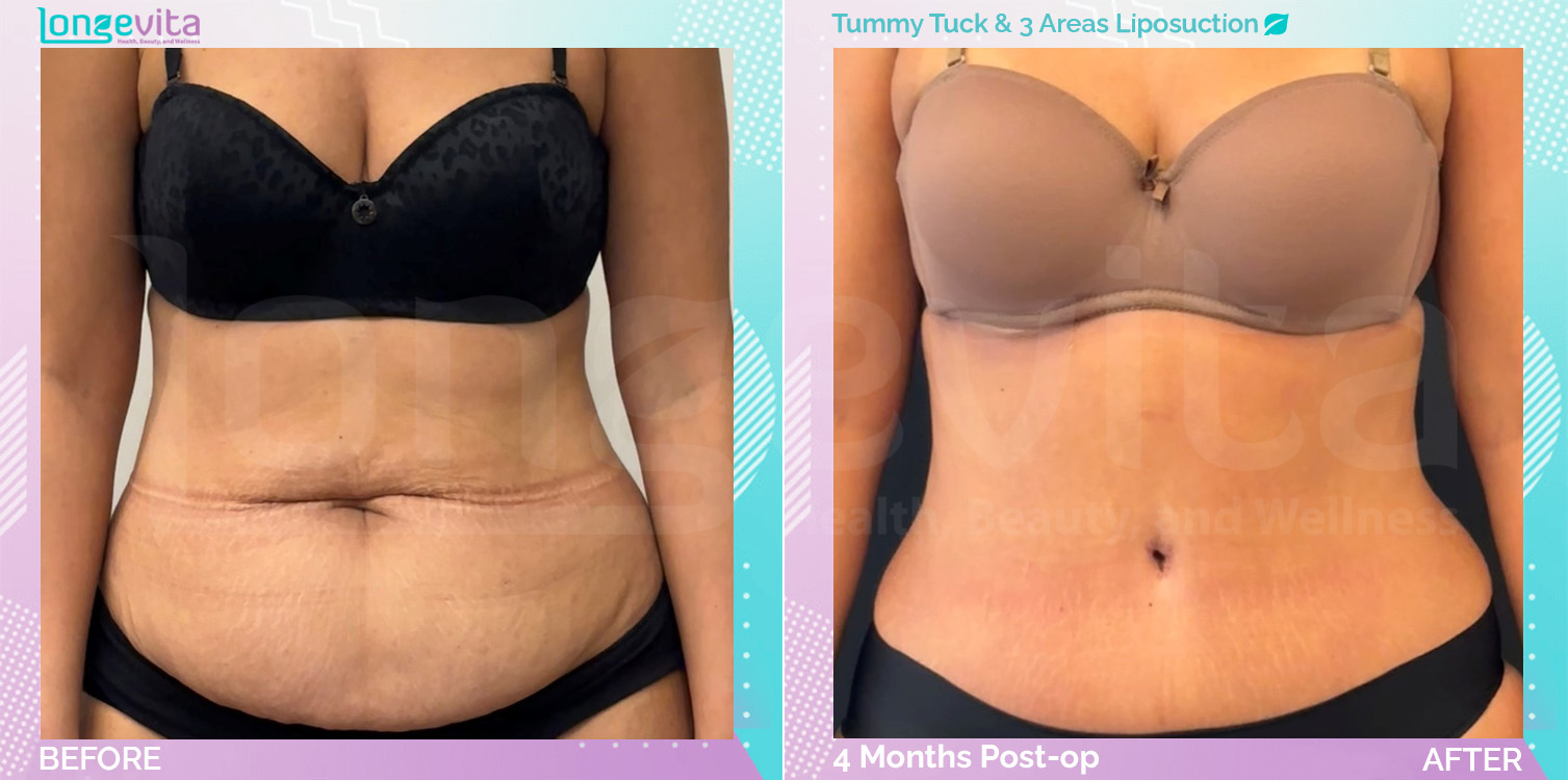 Liposuction and Tummy Tuck before and after, Body