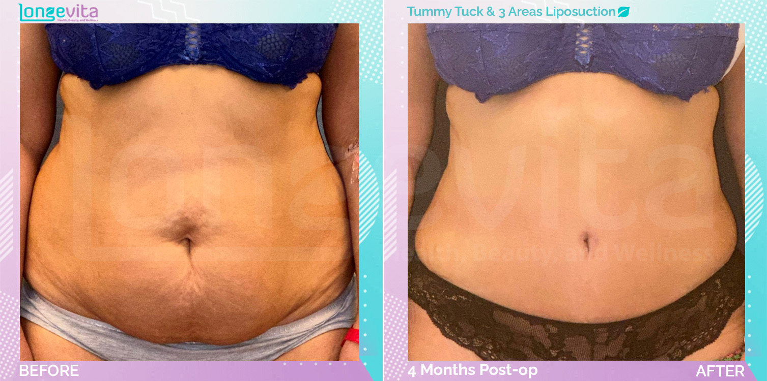 Liposuction and Tummy Tuck before and after, Body