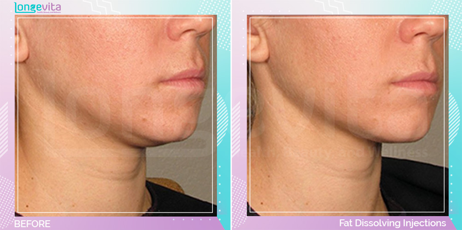 Fat Dissolving Injections before and after, Face