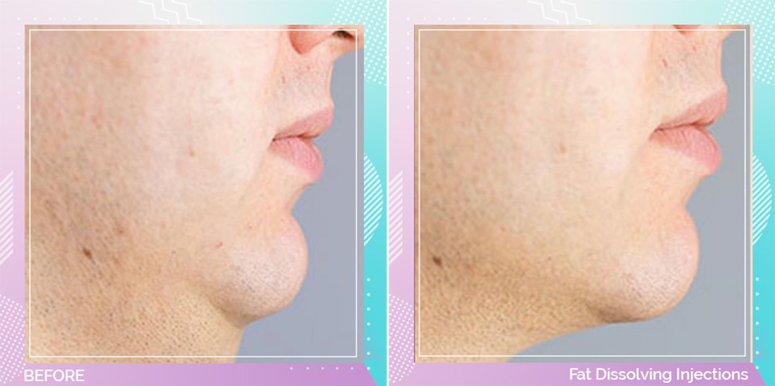 Fat Dissolving Injections before and after, Face