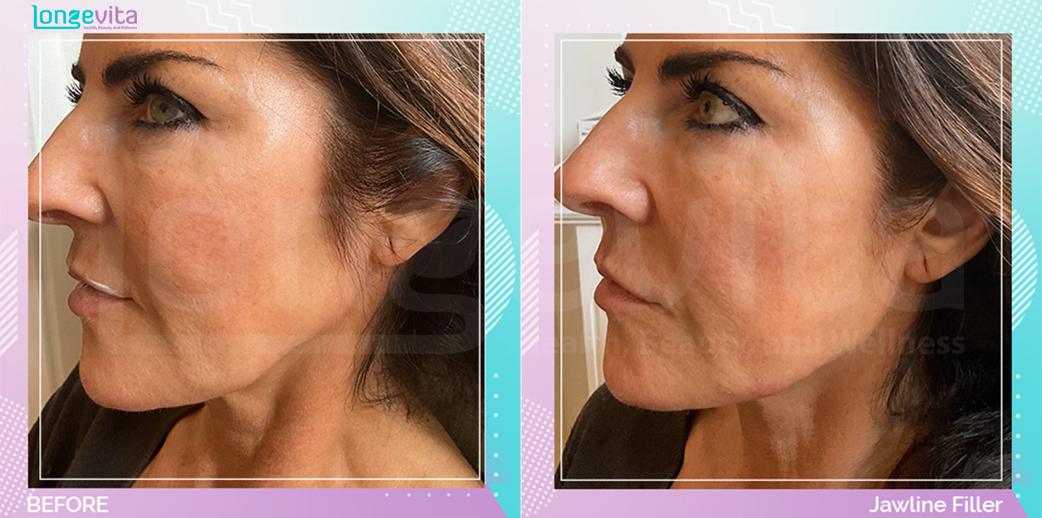Dermal Fillers before and after, Face