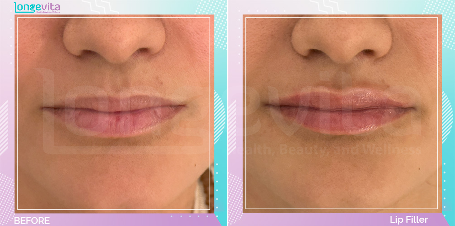 Dermal Fillers before and after, Face
