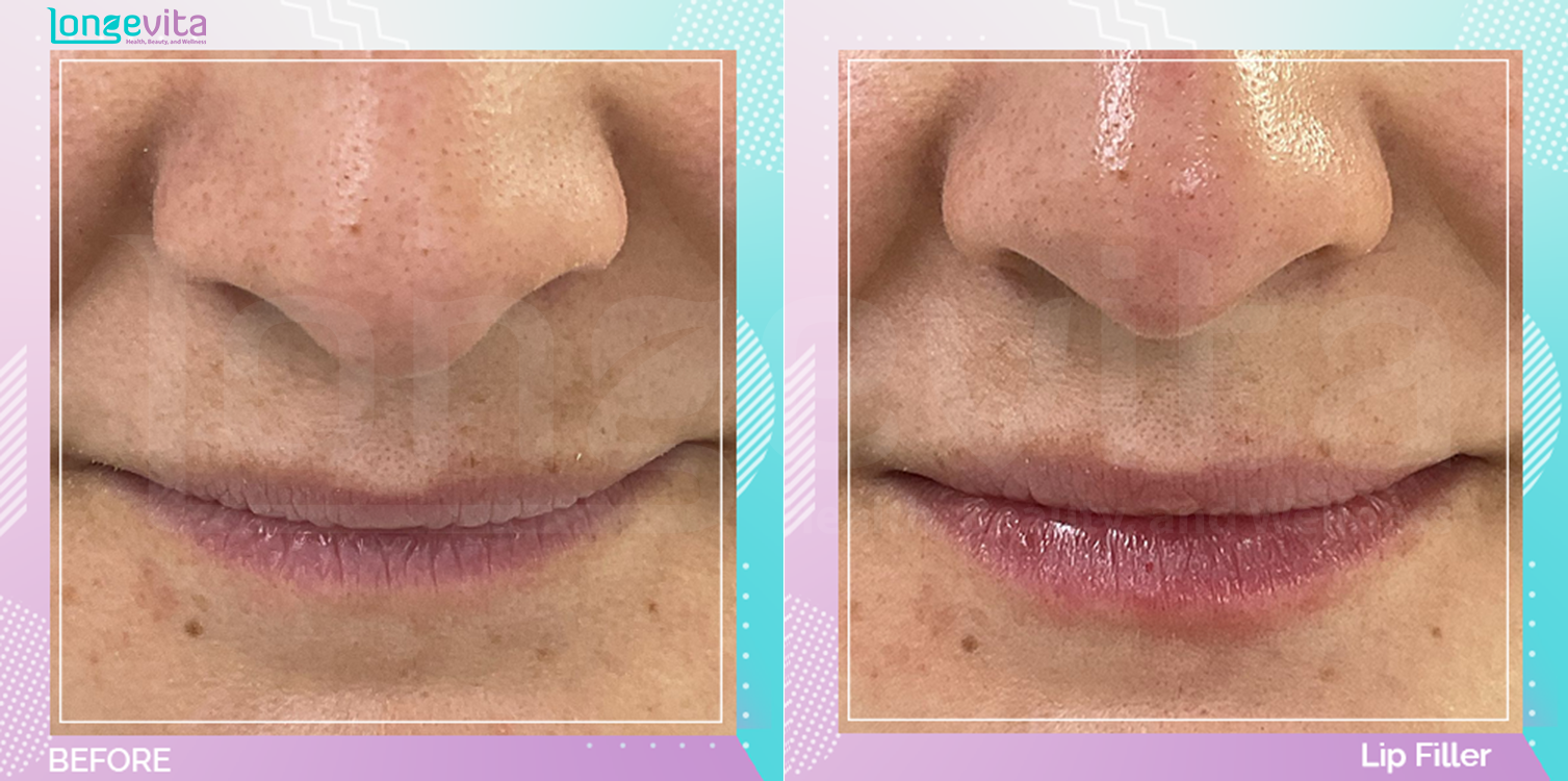 Dermal Fillers before and after, Face