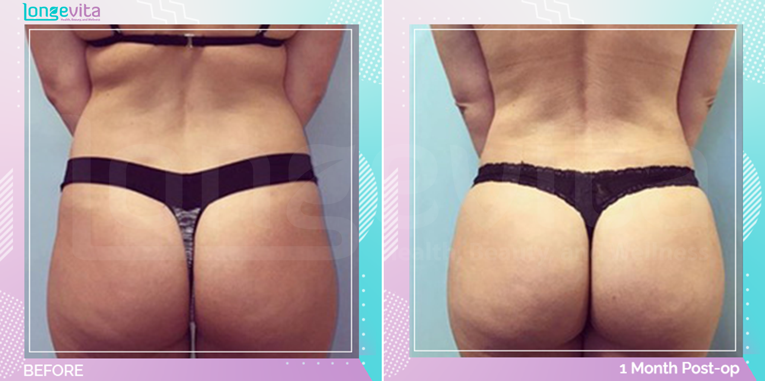 Bum Lift and Liposuction before and after, Body