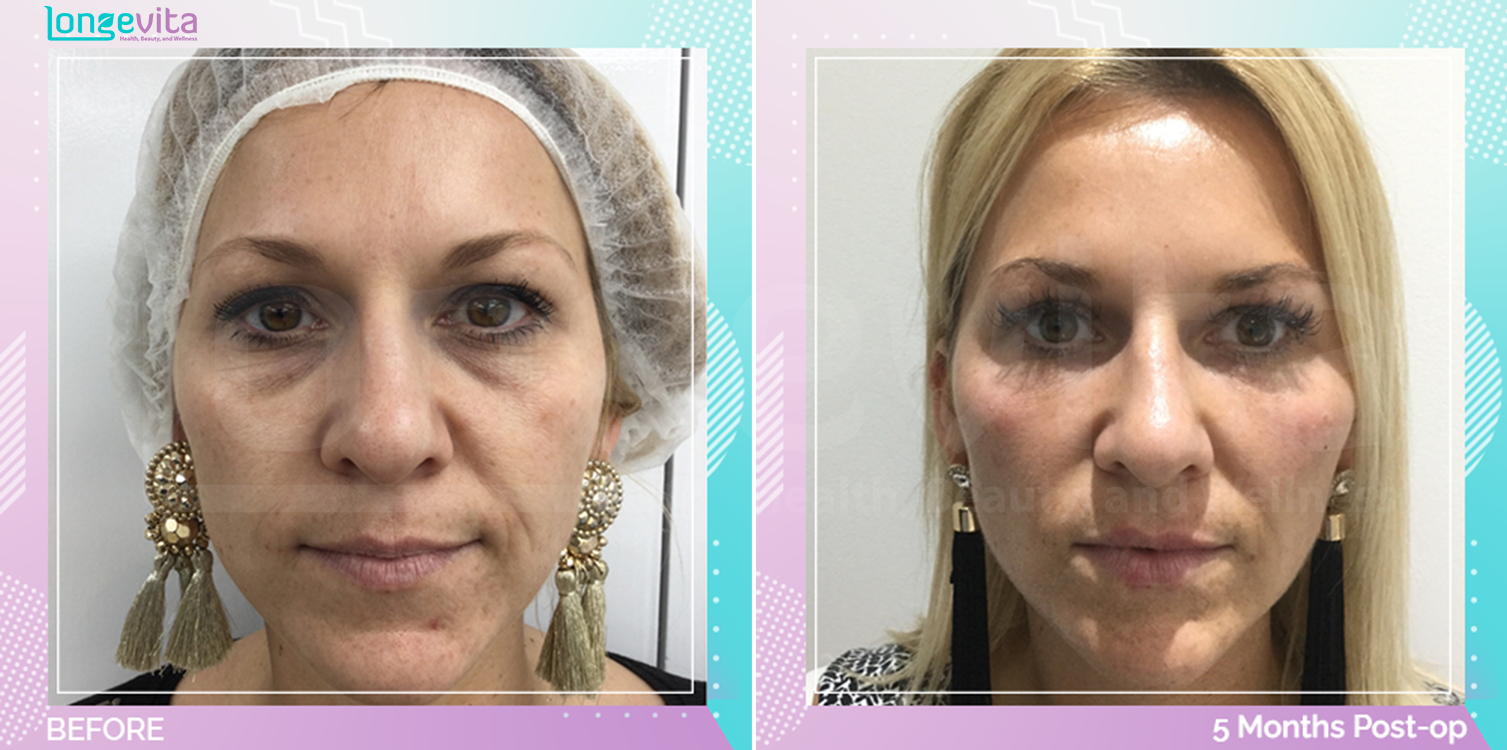 Eyelid and Mid Facelift before and after, Face