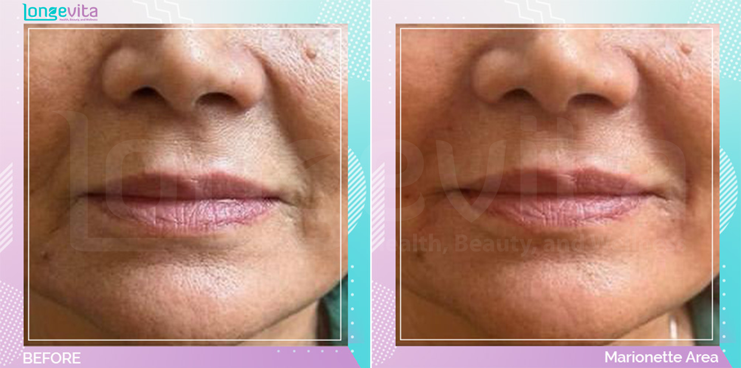 Dermal Fillers before and after, Face