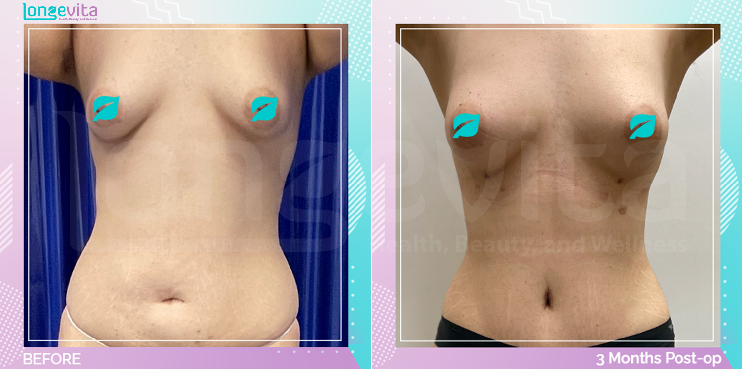 Breast Enlargement and Liposuction and Tummy Tuck before and after, Body