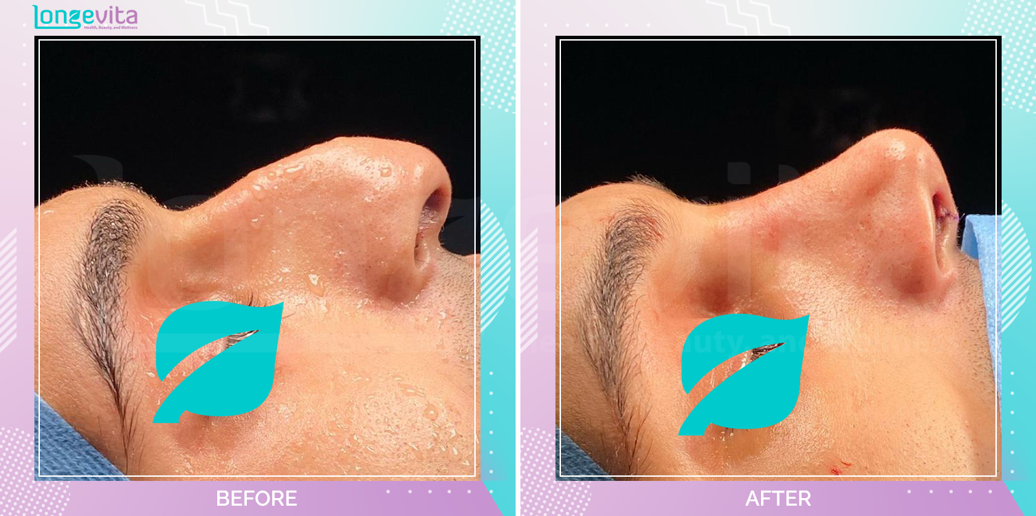 Rhinoplasty before and after, Face