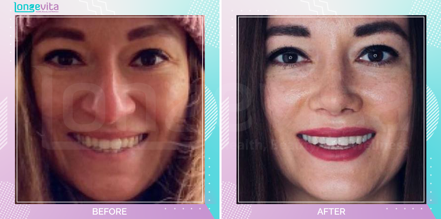 Rhinoplasty before and after, Face