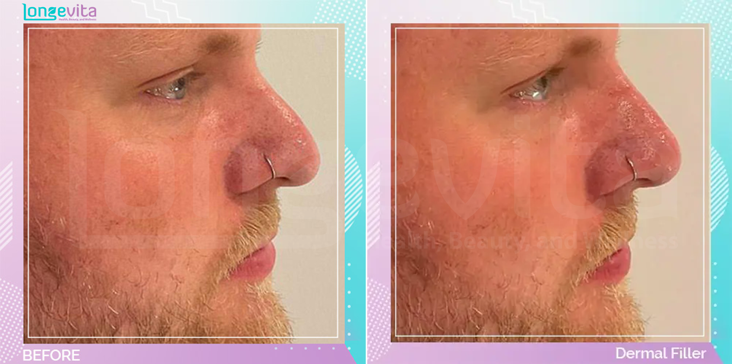 Dermal Fillers before and after, Face