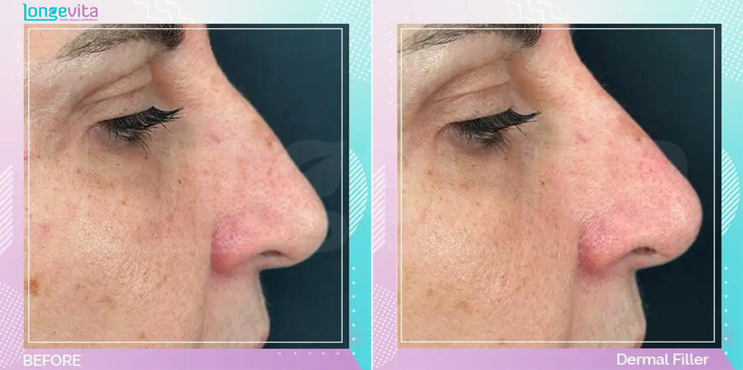 Dermal Fillers before and after, Face