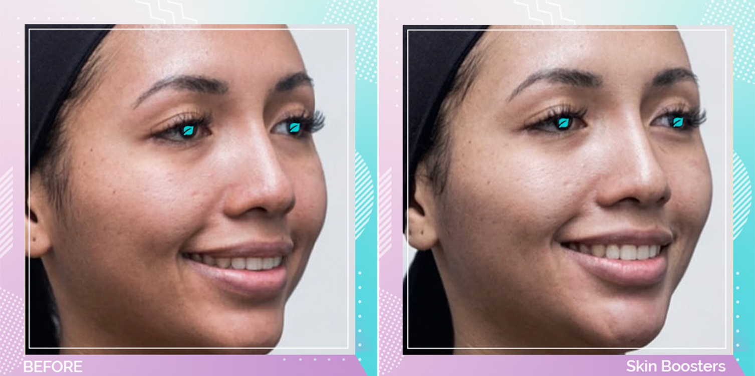 Skin Boosters before and after, Face